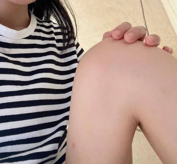またかまれた