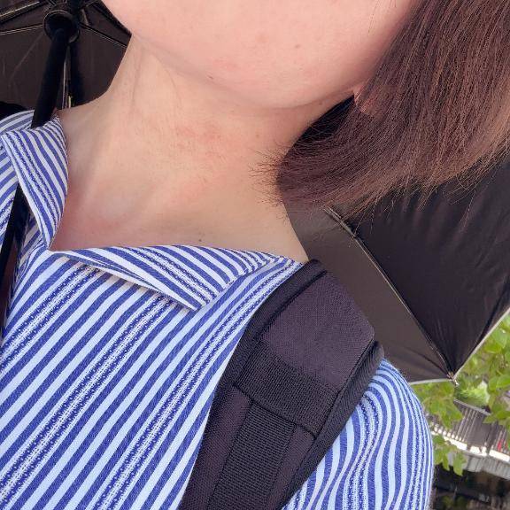 日光アレルギー☀️