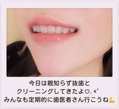 人生最初で最後の親知らず