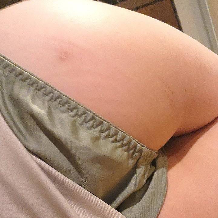ぽっつりおちり?